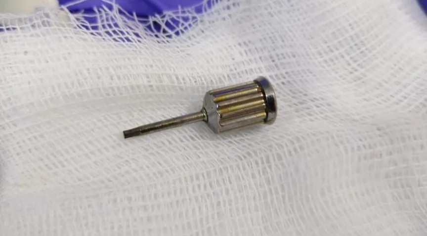 Медики ЦГБ №20 Екатеринбурга успешно извлекли стоматологическую отвёртку из кишечника женщины. Медики ЦГБ №20 Екатеринбурга успешно извлекли стоматологическую отвёртку из кишечника женщины.